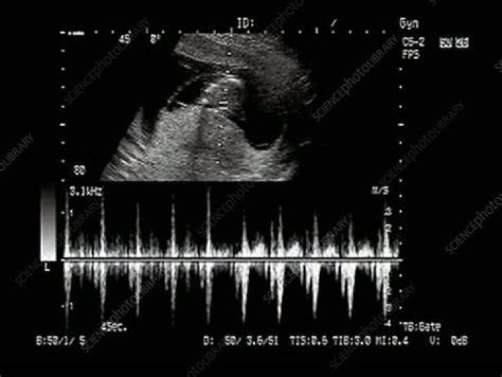 heartbeat ultrasound scan heartbeat ultrasound scan