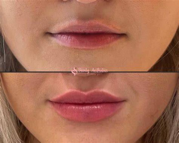 Lip Surgery, Lip Fillers, Fillers