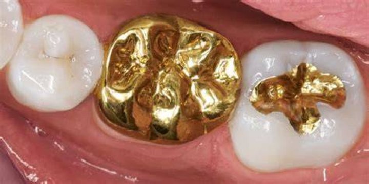 Permanent Gold Teeth Cost