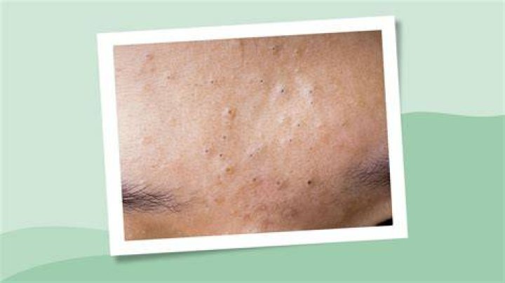 What Is Acne Extraction? - Kylon Powell